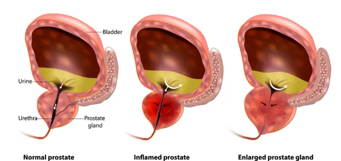 Medical illustration showing prostate progression from normal to inflamed to enlarged prostate gland